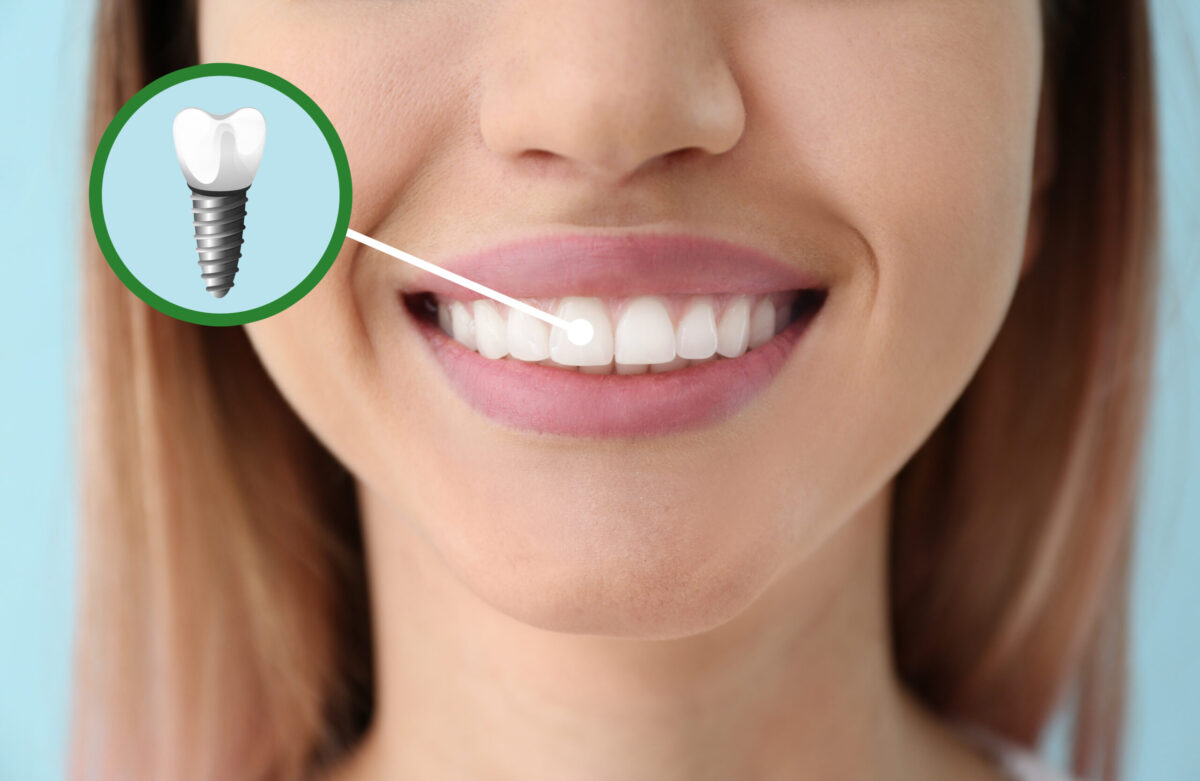 The Benefits of Mini Dental Implants