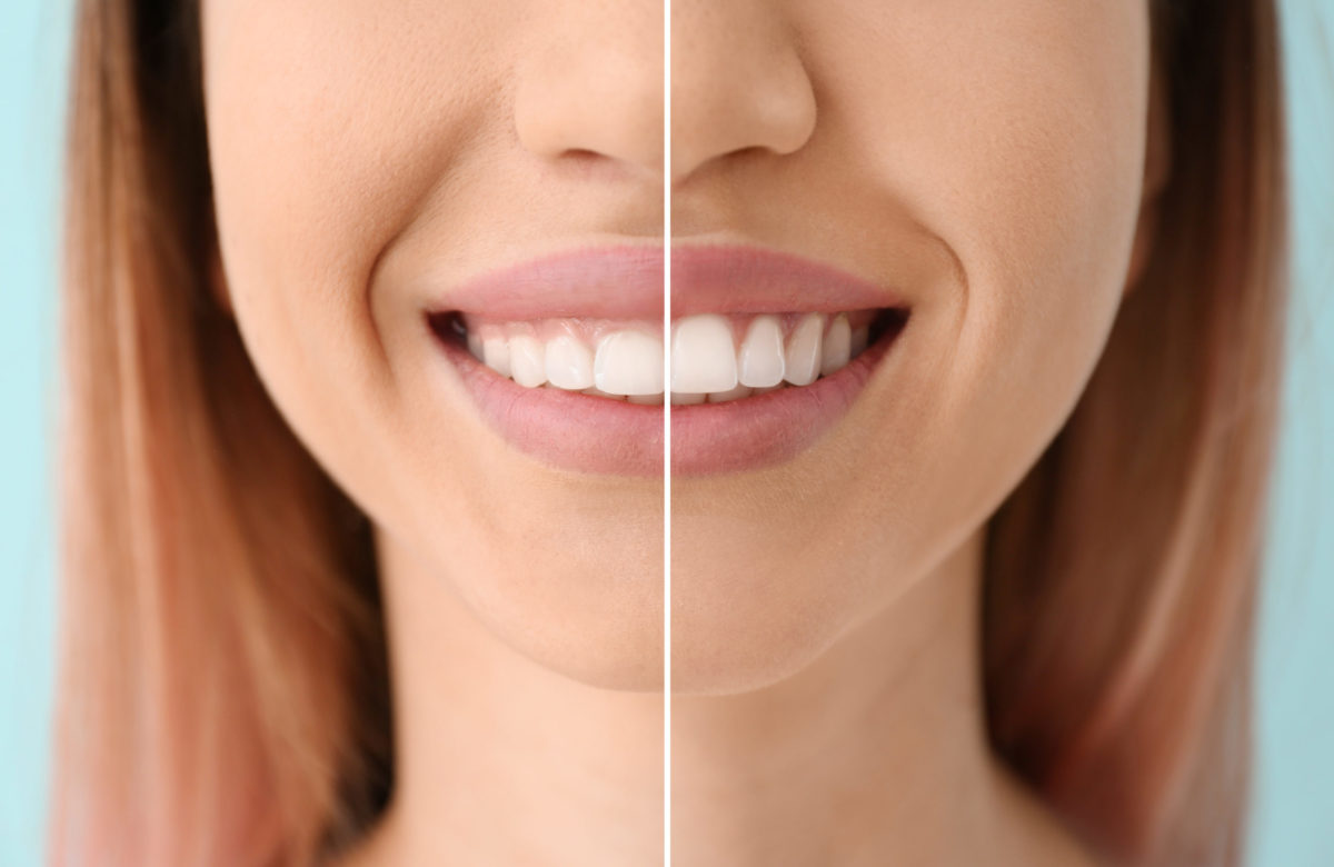 3 Permanent Options for Cosmetic Dentistry