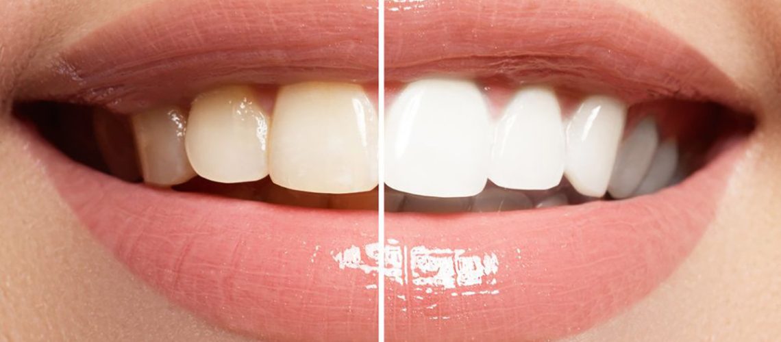 Teeth-Whitening-Before-Special-Events-crop